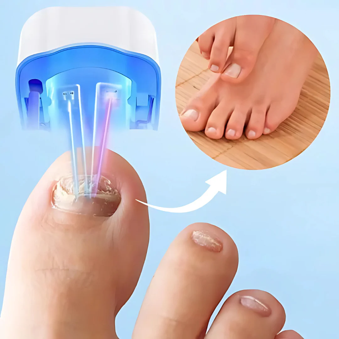 Nail Treatment Laser Device for Fungal Care - Image 4